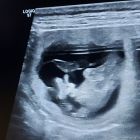 L-Wurf Ultraschall mit 5 Wochen